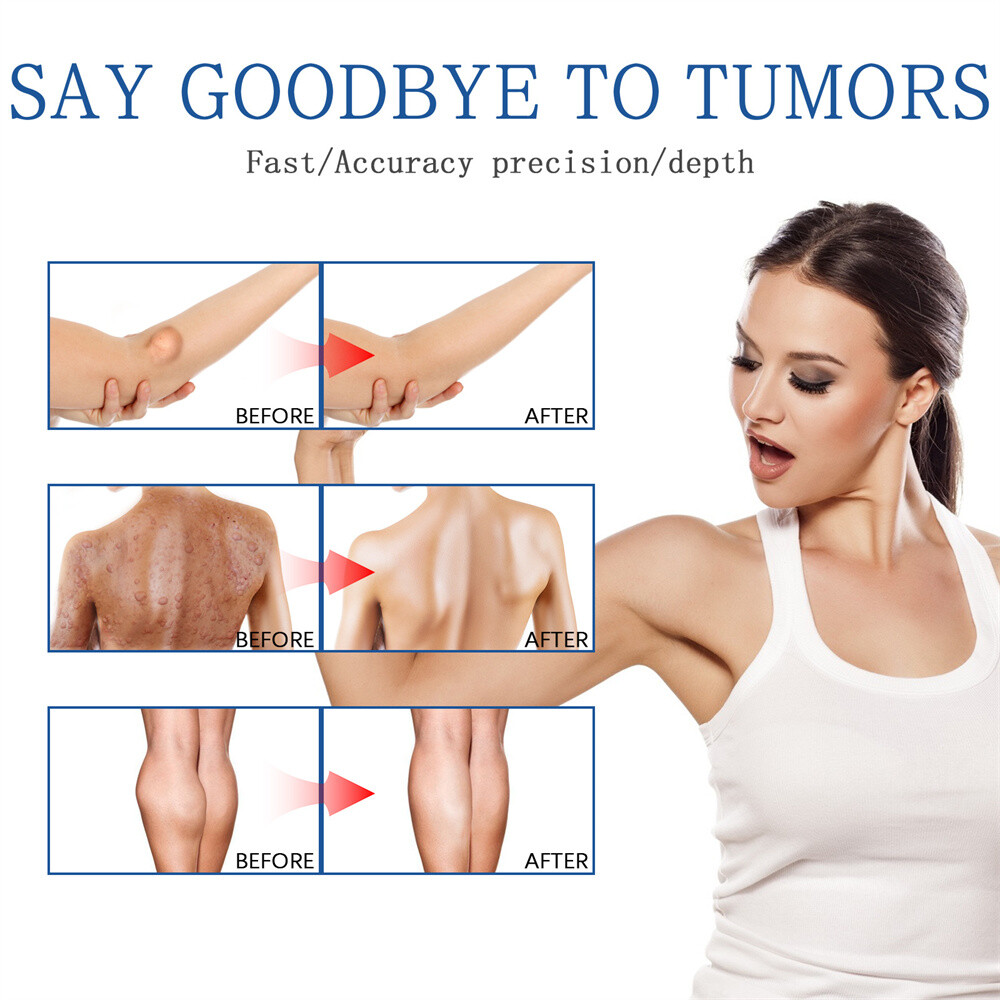 50ML Lipomheilung Reduction Spray, Instant LumpFree Lipoma Removal Spray
