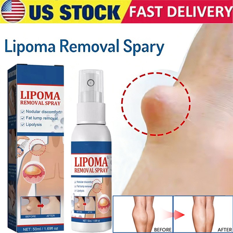 50ML Lipomheilung Reduction Spray, Instant LumpFree Lipoma Removal Spray