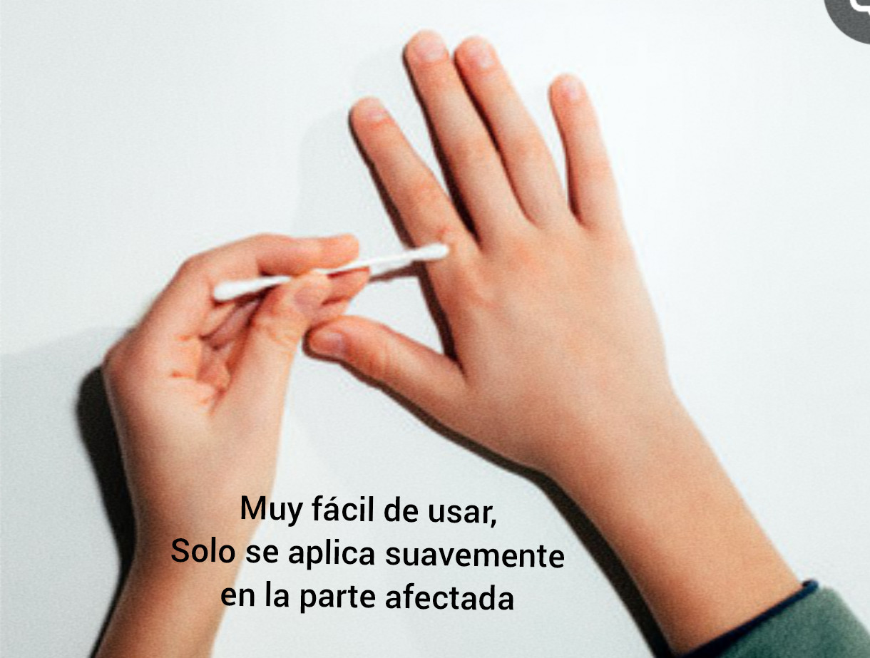 Remedio Para mezquinos o verrugas vulgares en Manos y Cuerpo Funciona Sin Dolor