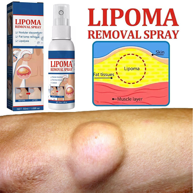 50ML Lipomheilung Reduction Spray, Instant LumpFree Lipoma Removal Spray USA Hot