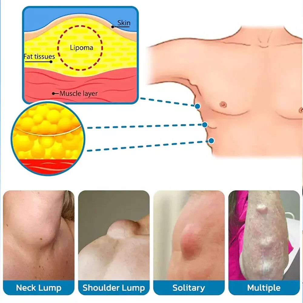 50ML Lipomheilung Reduction Spray, Instant LumpFree Lipoma Removal Spray