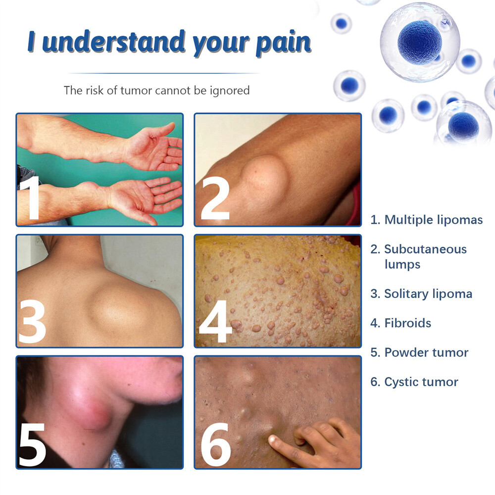 50ML Lipomheilung Reduction Spray, Instant LumpFree Lipoma Removal Spray