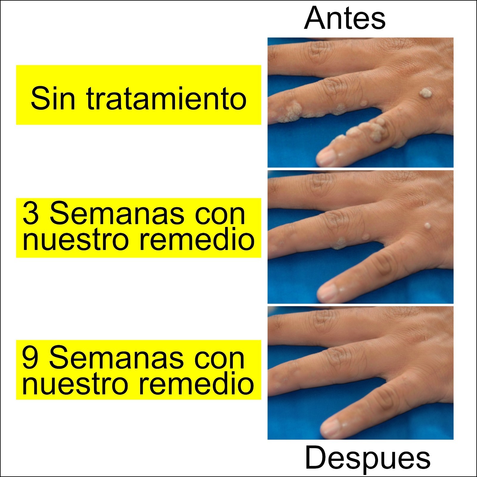 Remedio Para mezquinos o verrugas vulgares en Manos y Cuerpo Funciona Sin Dolor