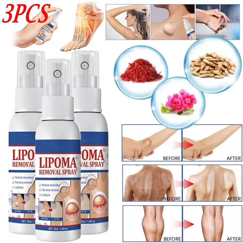 50ML Lipomheilung Reduction Spray, Instant LumpFree Lipoma Removal Spray USA Hot