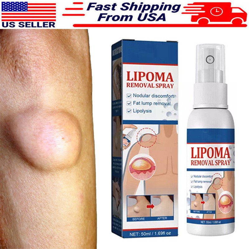 50ML Lipomheilung Reduction Spray, Instant LumpFree Lipoma Removal Spray USA Hot