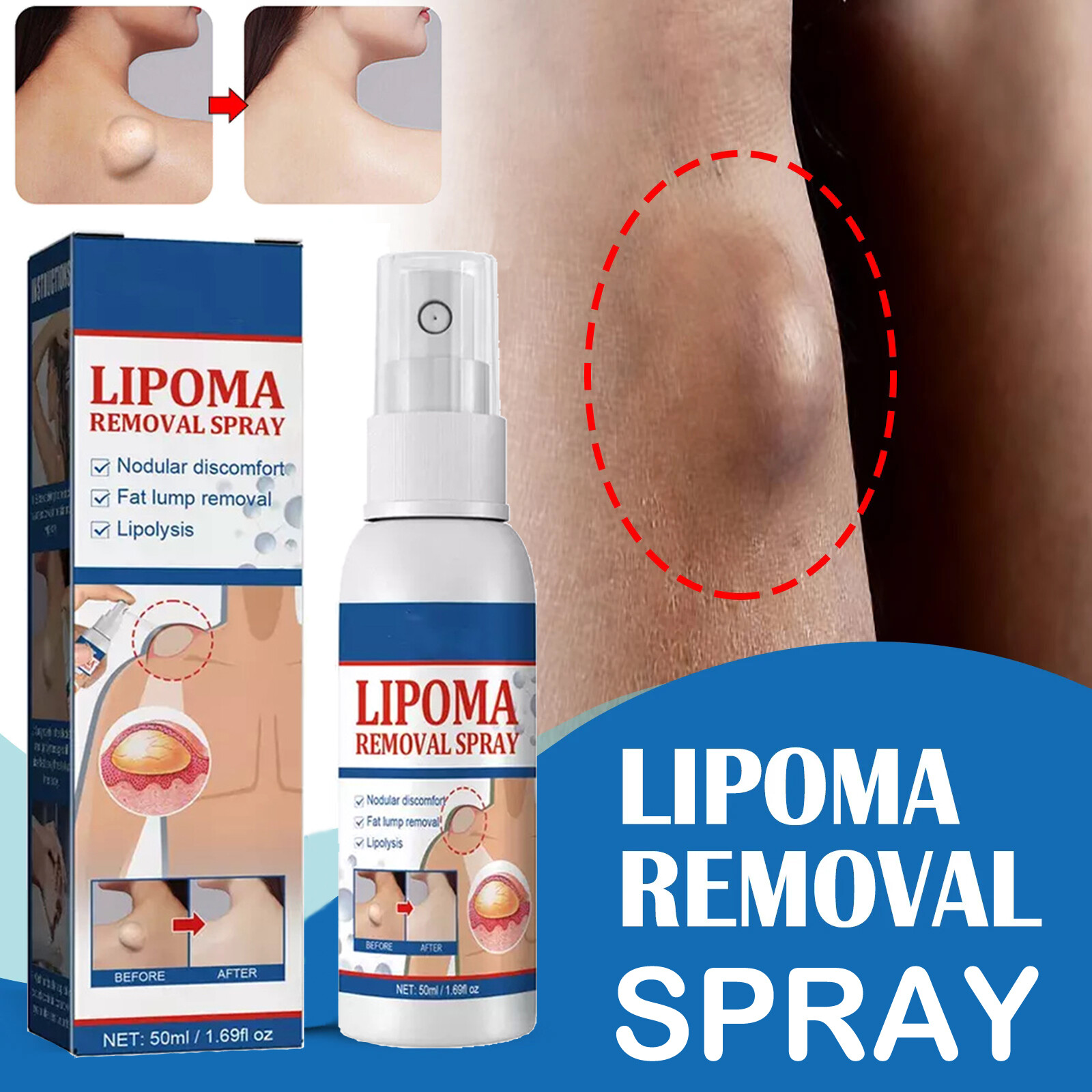 3X Lipomheilung Reduction Spray, Quick LumpFree Lipoma Removal Spray US