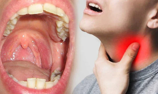 Adven Tonsicare Tablet, relief from inflamed tonsils and follicular tonsillitis